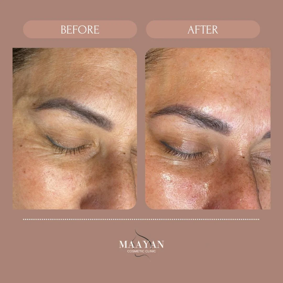 מתיחת קמטים