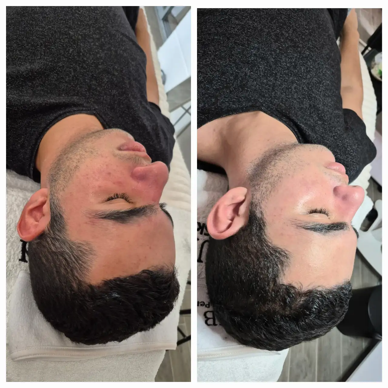 טיפול באקנה 