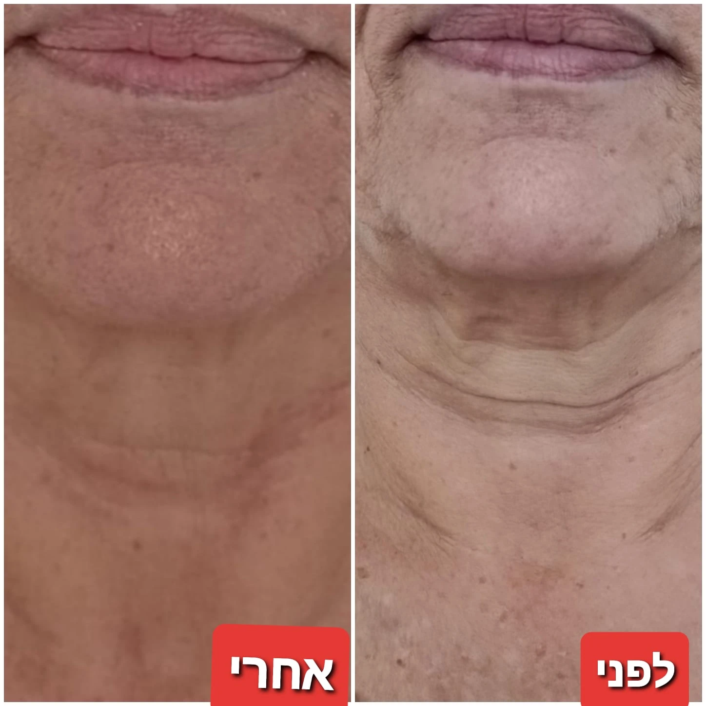 טיפולי פנים: אנטי אייגי'נג + גלי רדיו RF + מזותרפיה