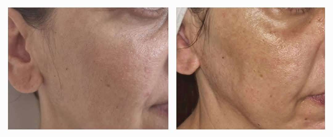 טיפול הייפו (HIFU)