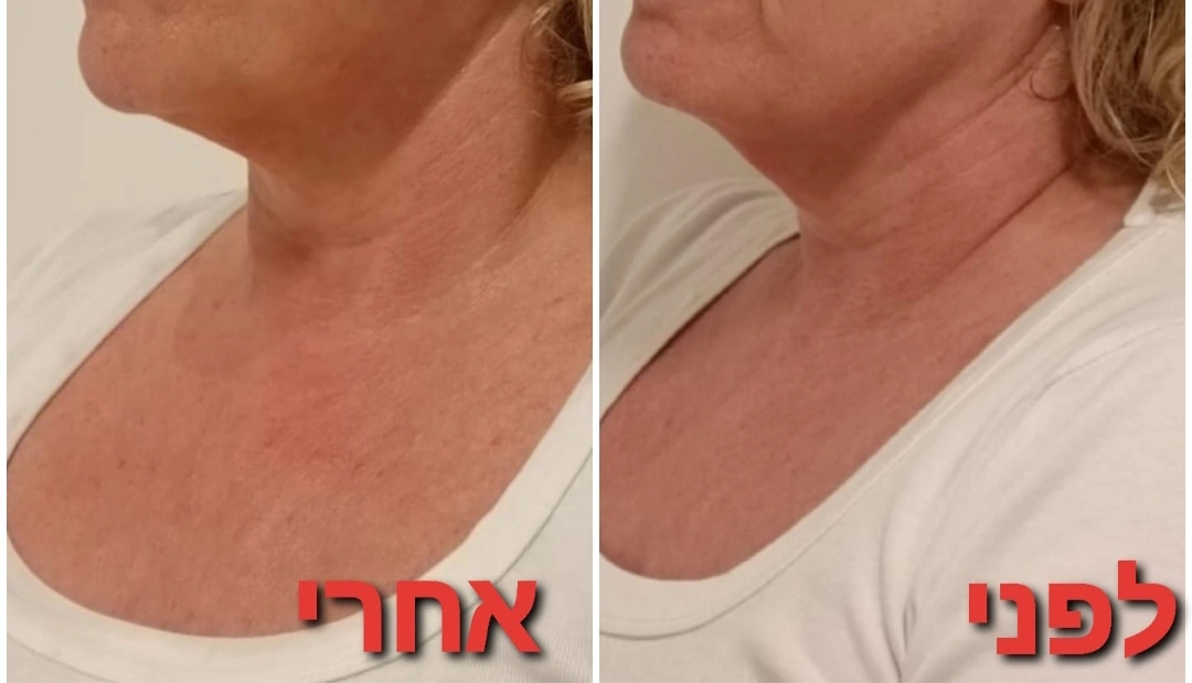 טיפולי פנים: אנטי אייגי'נג + גלי רדיו RF + מזותרפיה