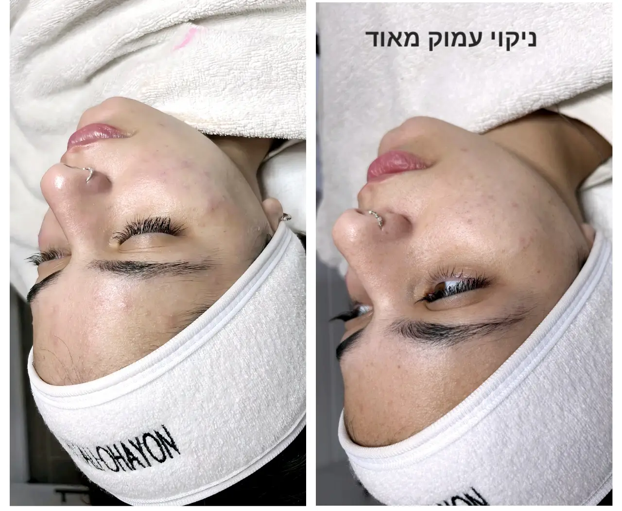 טיפול באקנה 