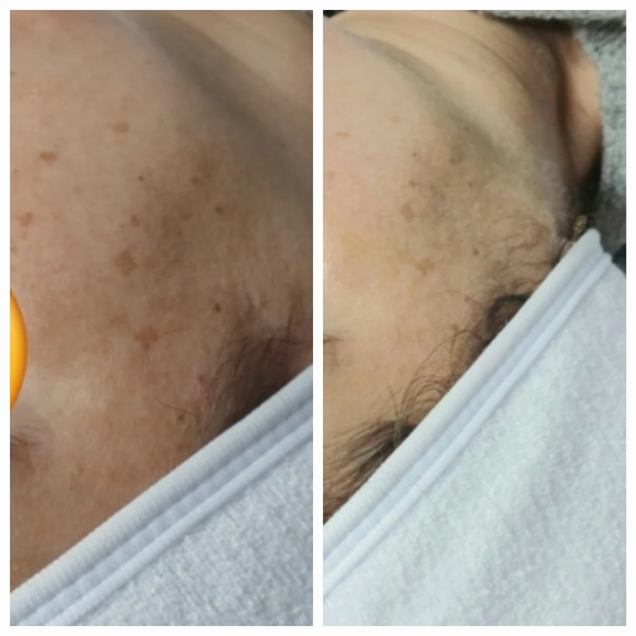 טיפול בפיגמנטציה 