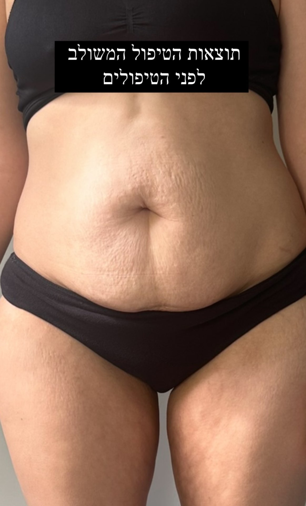 טיפולי גוף משולב - פרסותרפיה וואקום 