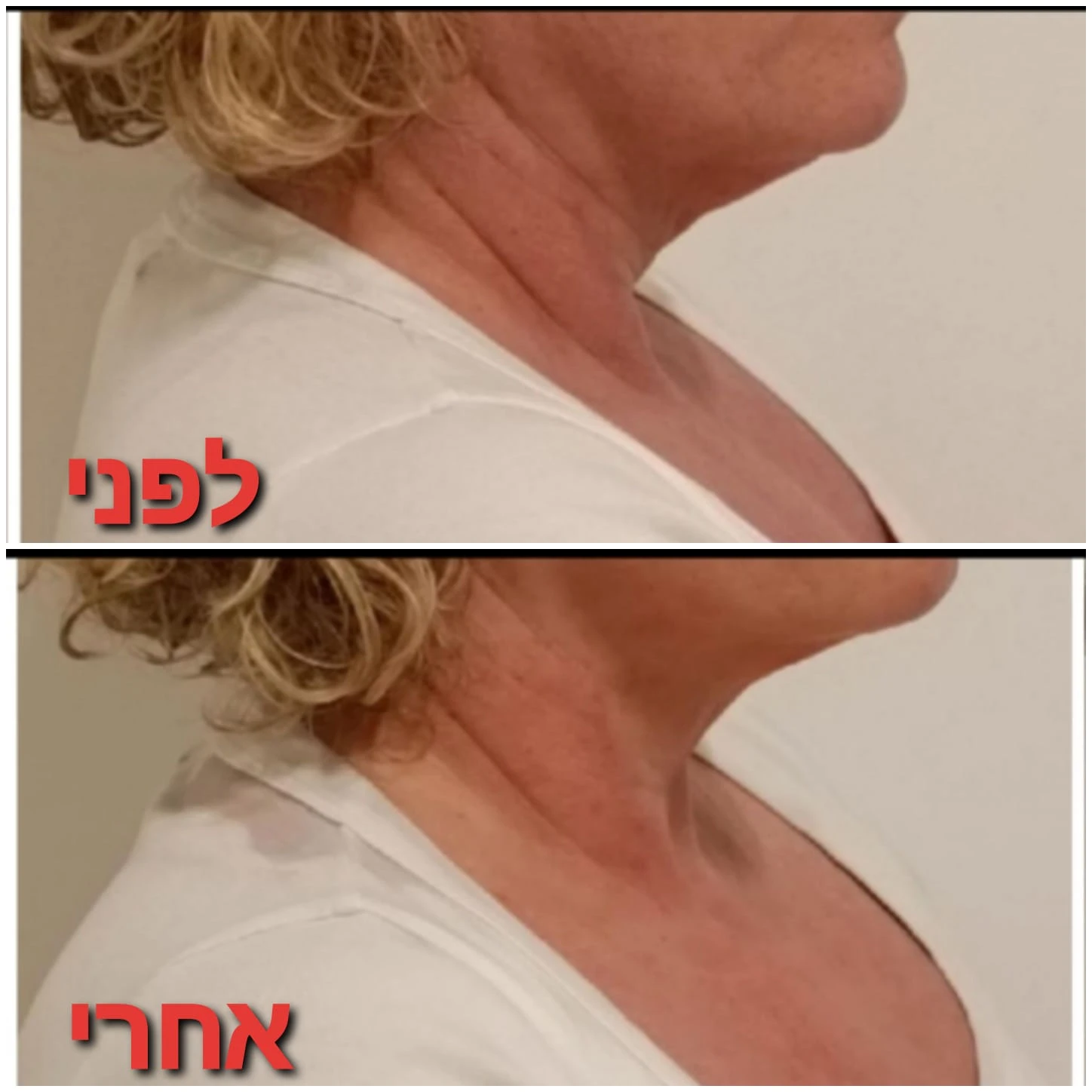 טיפולי פנים: אנטי אייגי'נג + גלי רדיו RF + מזותרפיה