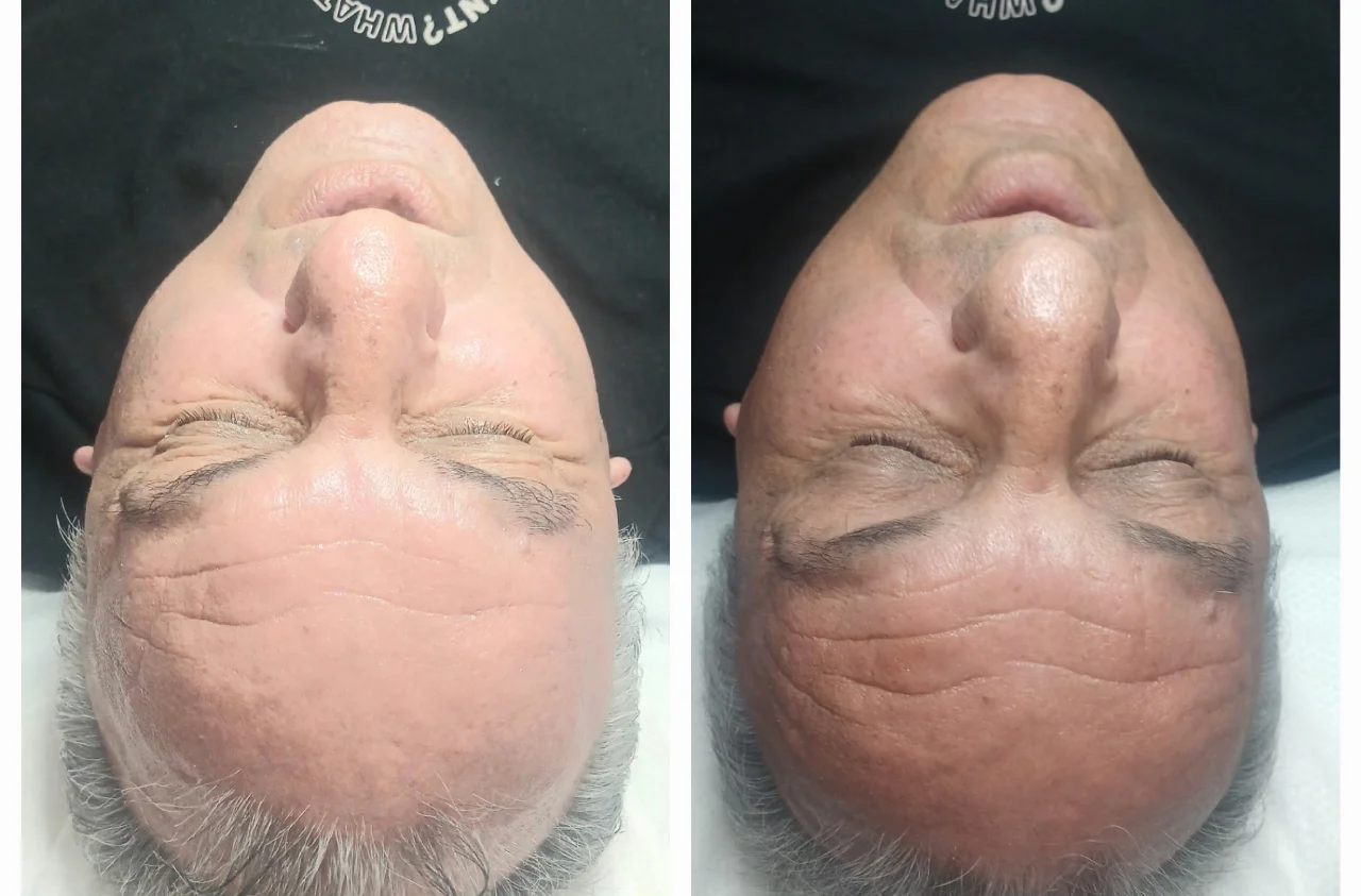 טיפול אייגינג  ומיצוק העור בשיטת RF