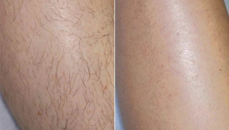 טיפולי לייזר להסרת שיער ללא כאבים