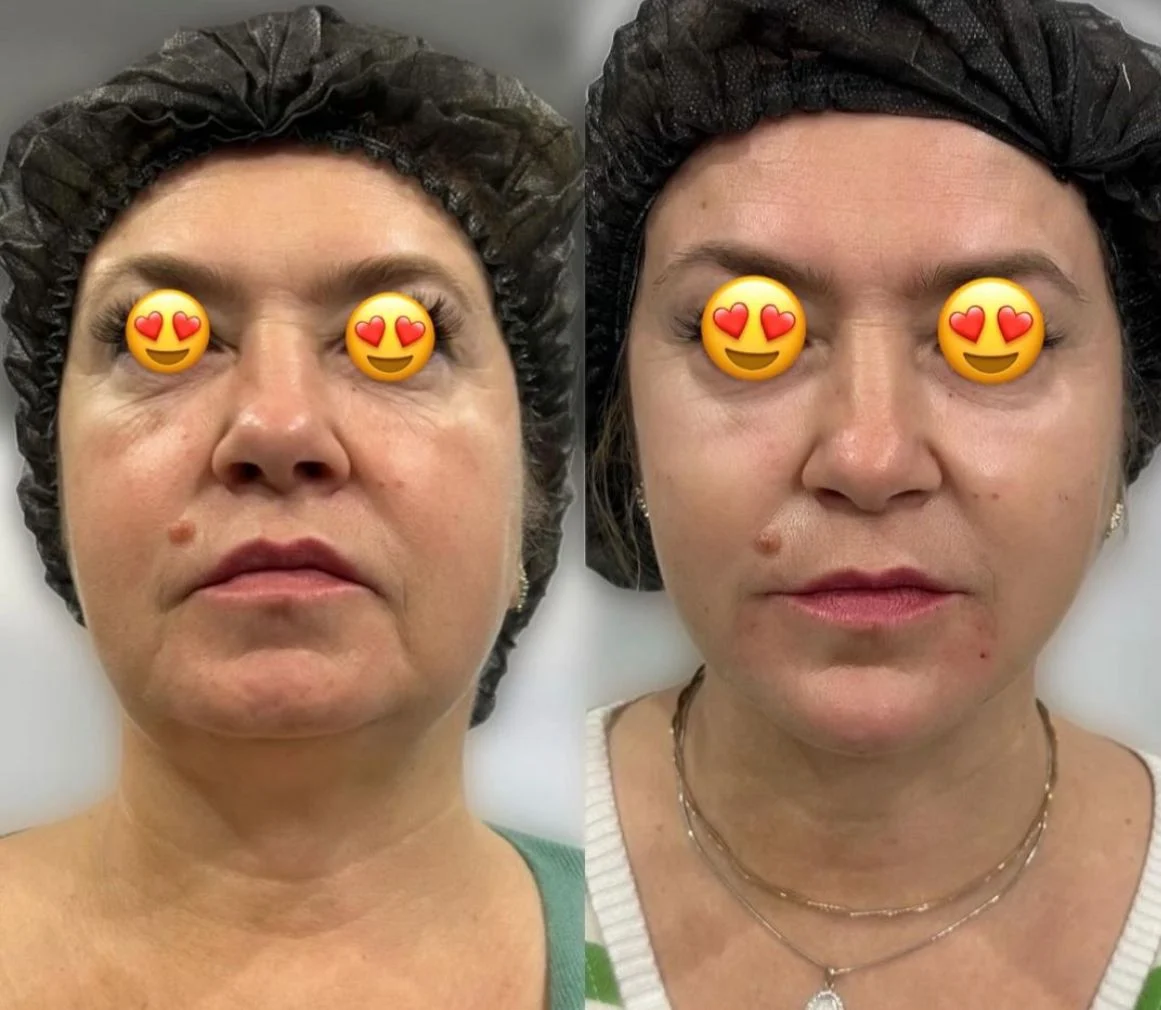 טיפולי אסתטיקה (הזרקות)