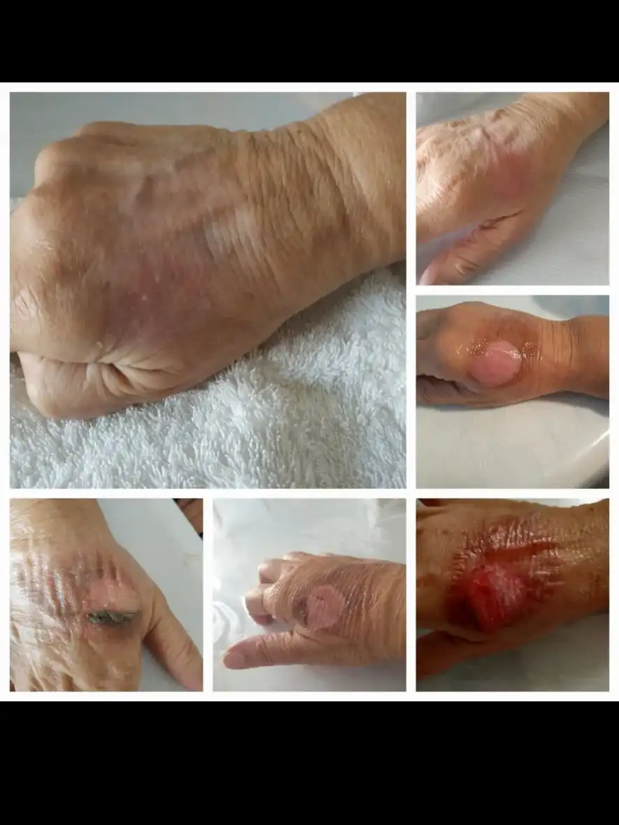 טיפול בכוויה דרגה 2 ממים רותחים.