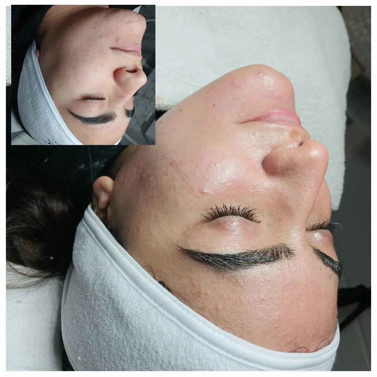 טיפול באקנה 