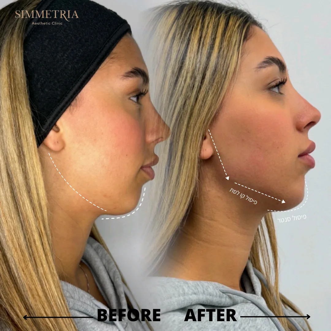 פיסול קו לסת וסנטר