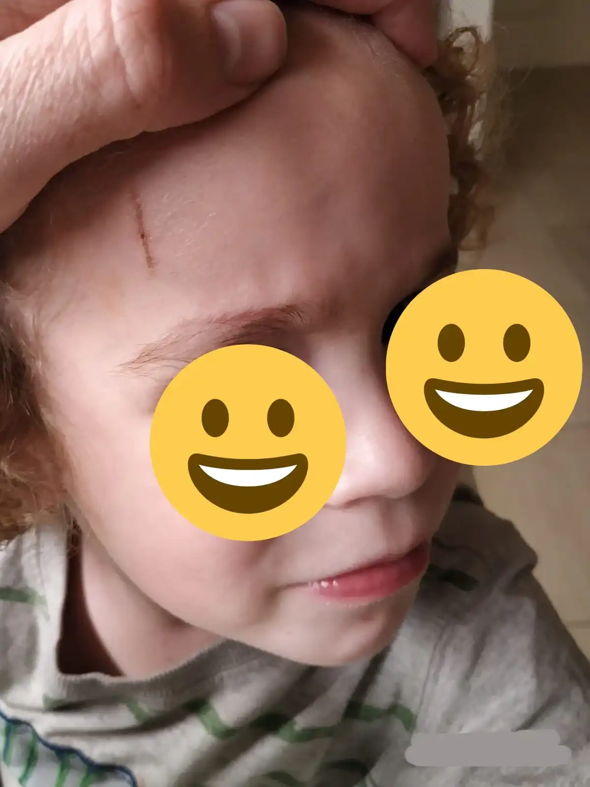 חתך מעל הגבה