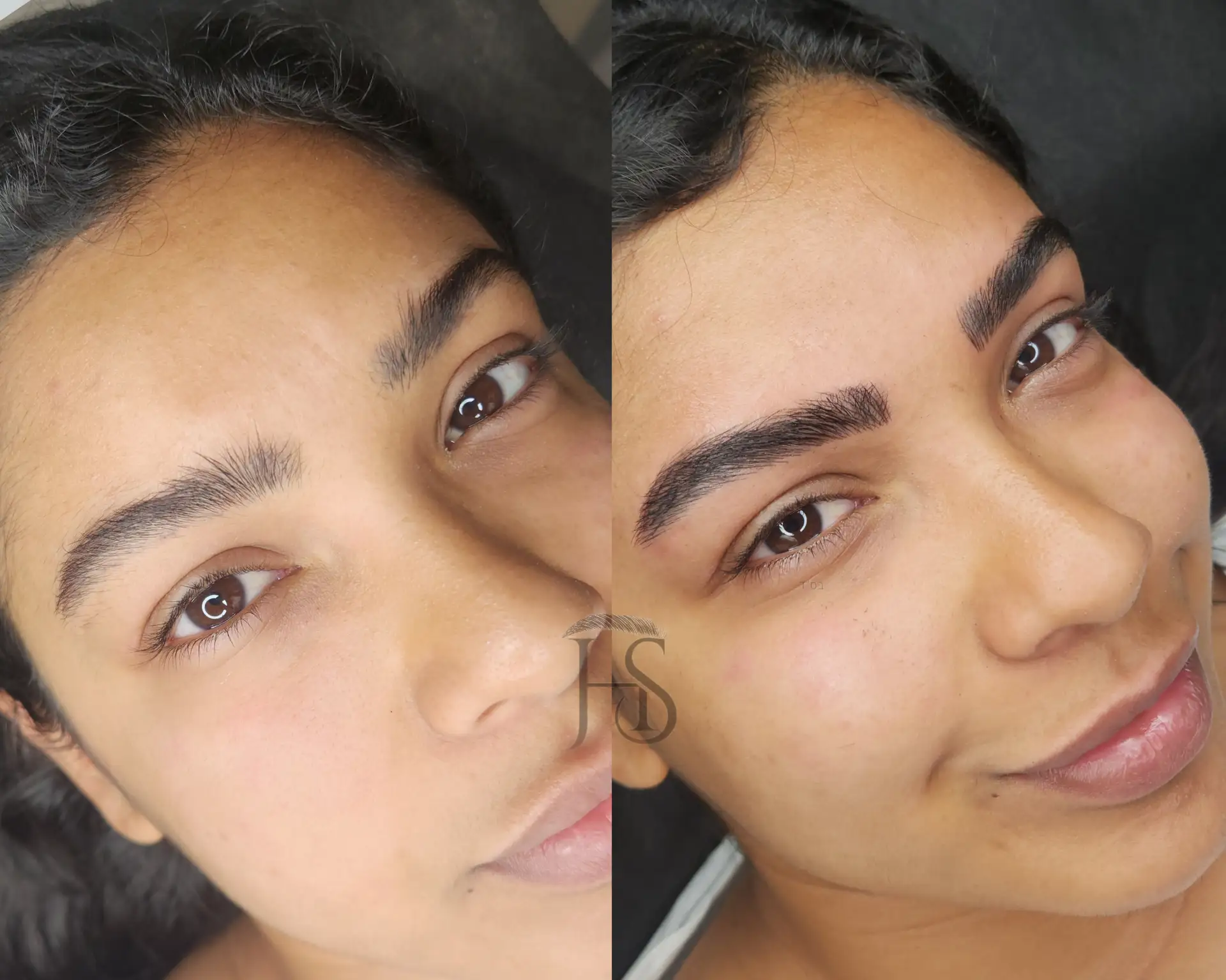 מיקרובליידינג