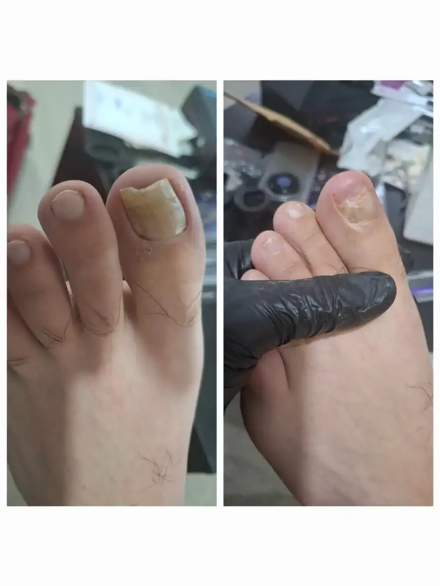 פדיקור מקצועי בציפורנים לאחר חבלה וציפורן חודרנית.