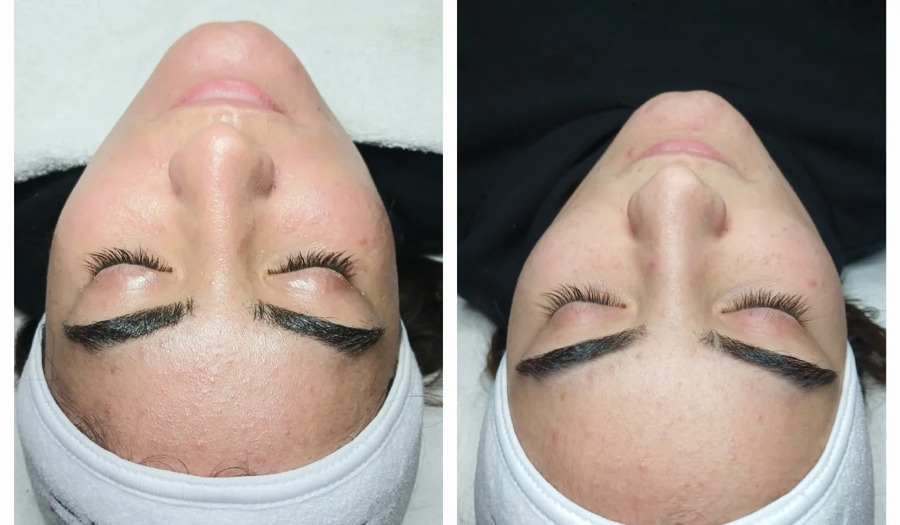  טיפול מיגור דלקת האקנה