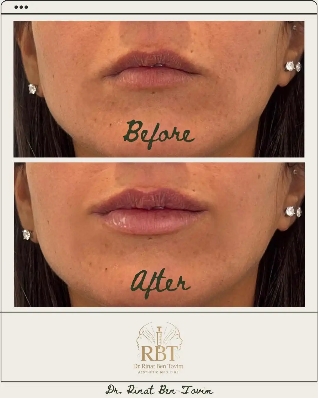 בוטוקס חומצה היאלורונית