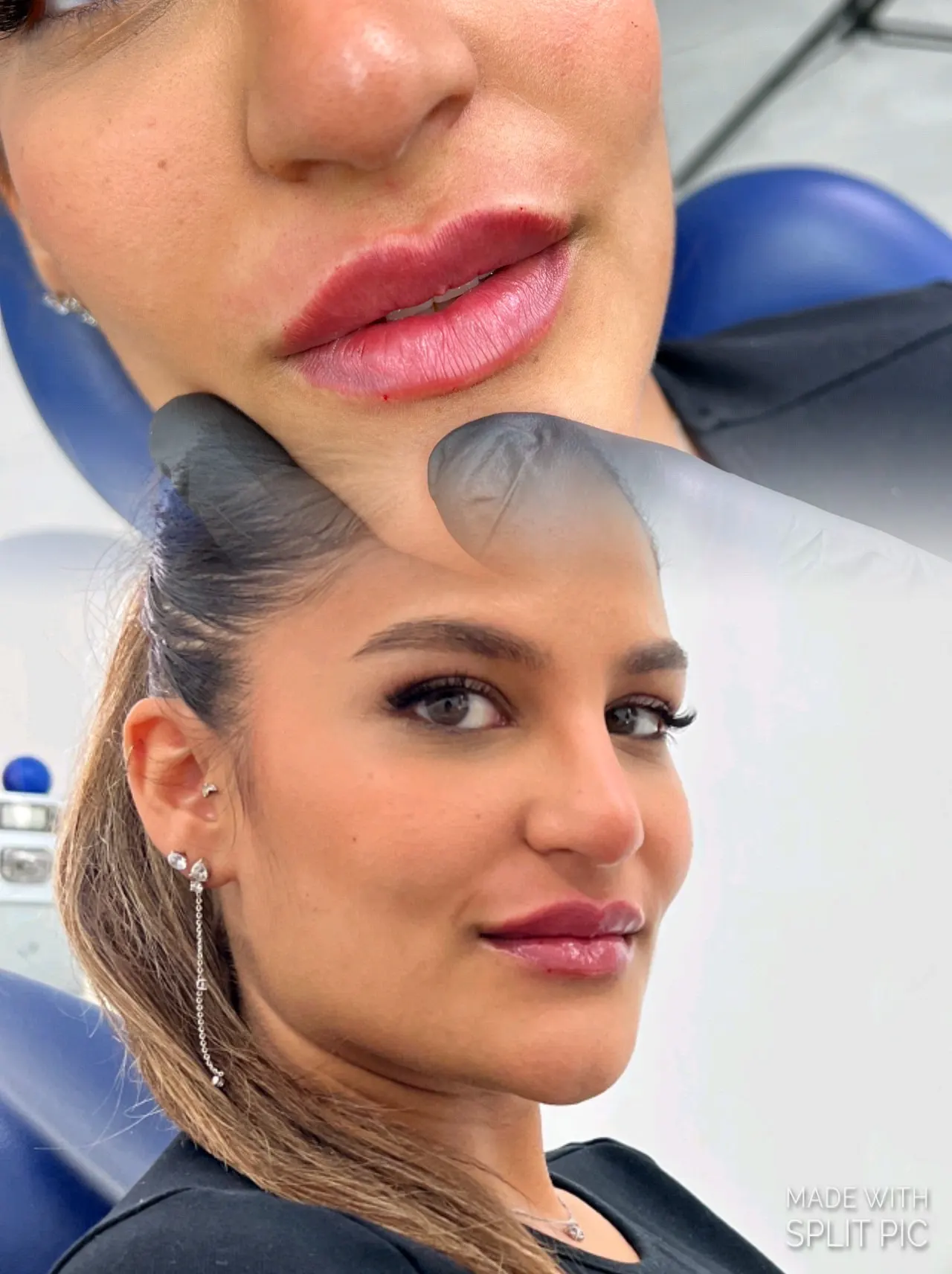 מיני ליפט – מתיחת פנים וצוואר עם בוטוקס וביוסטימולטורים