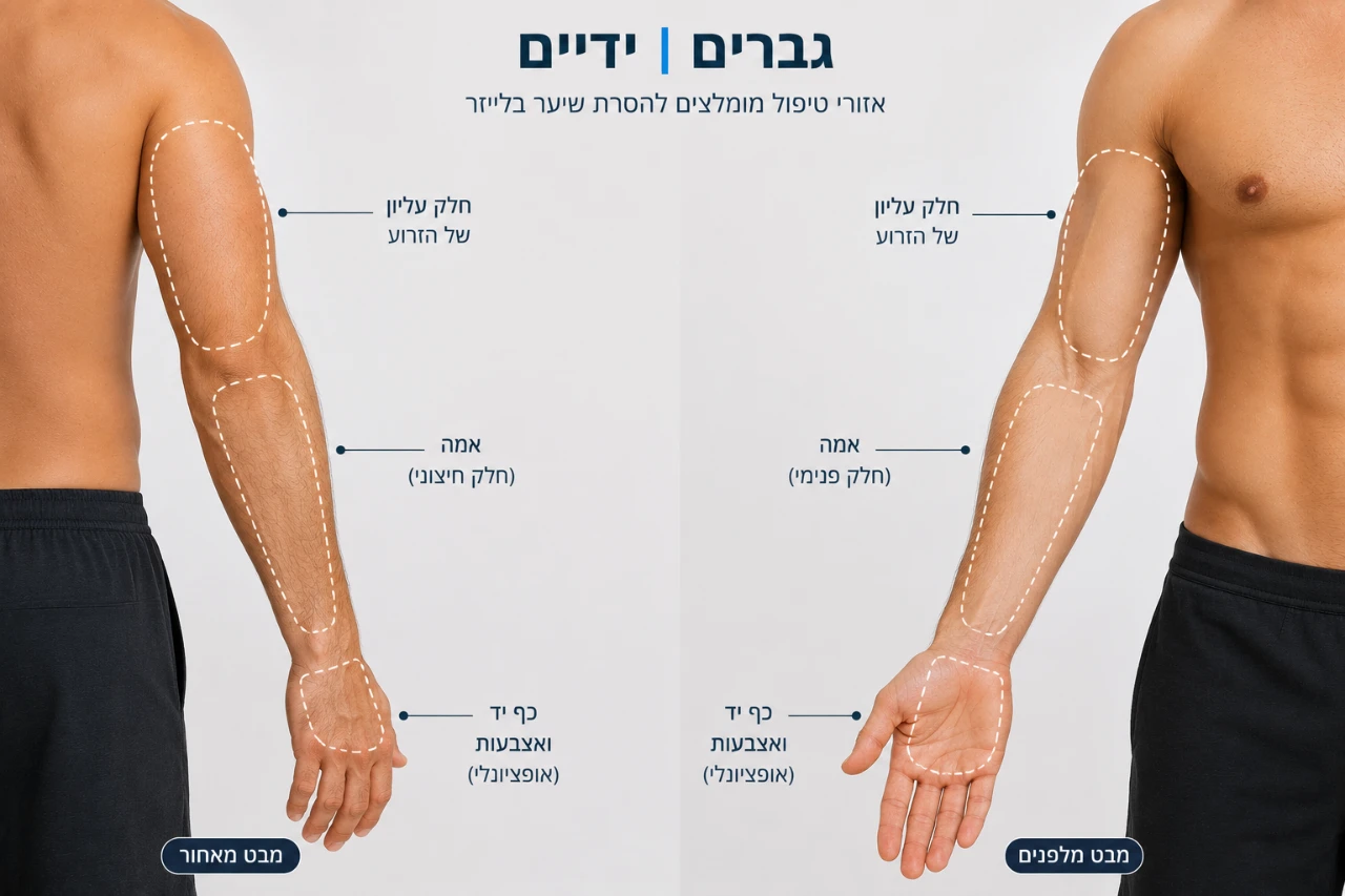 הסרת שיער ידיים מלא גבר 10 טיפולים