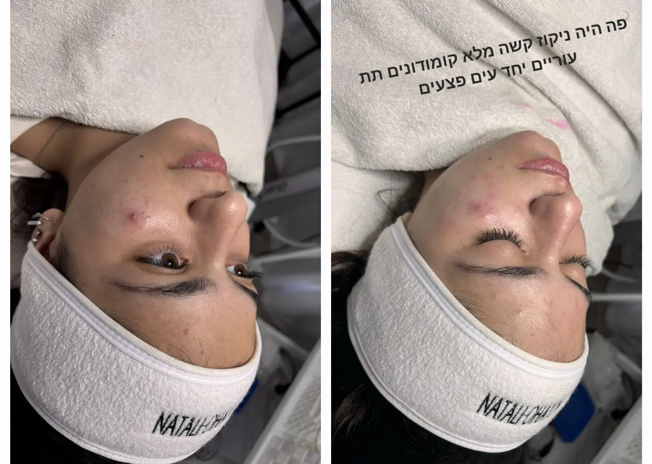 טיפול באקנה 