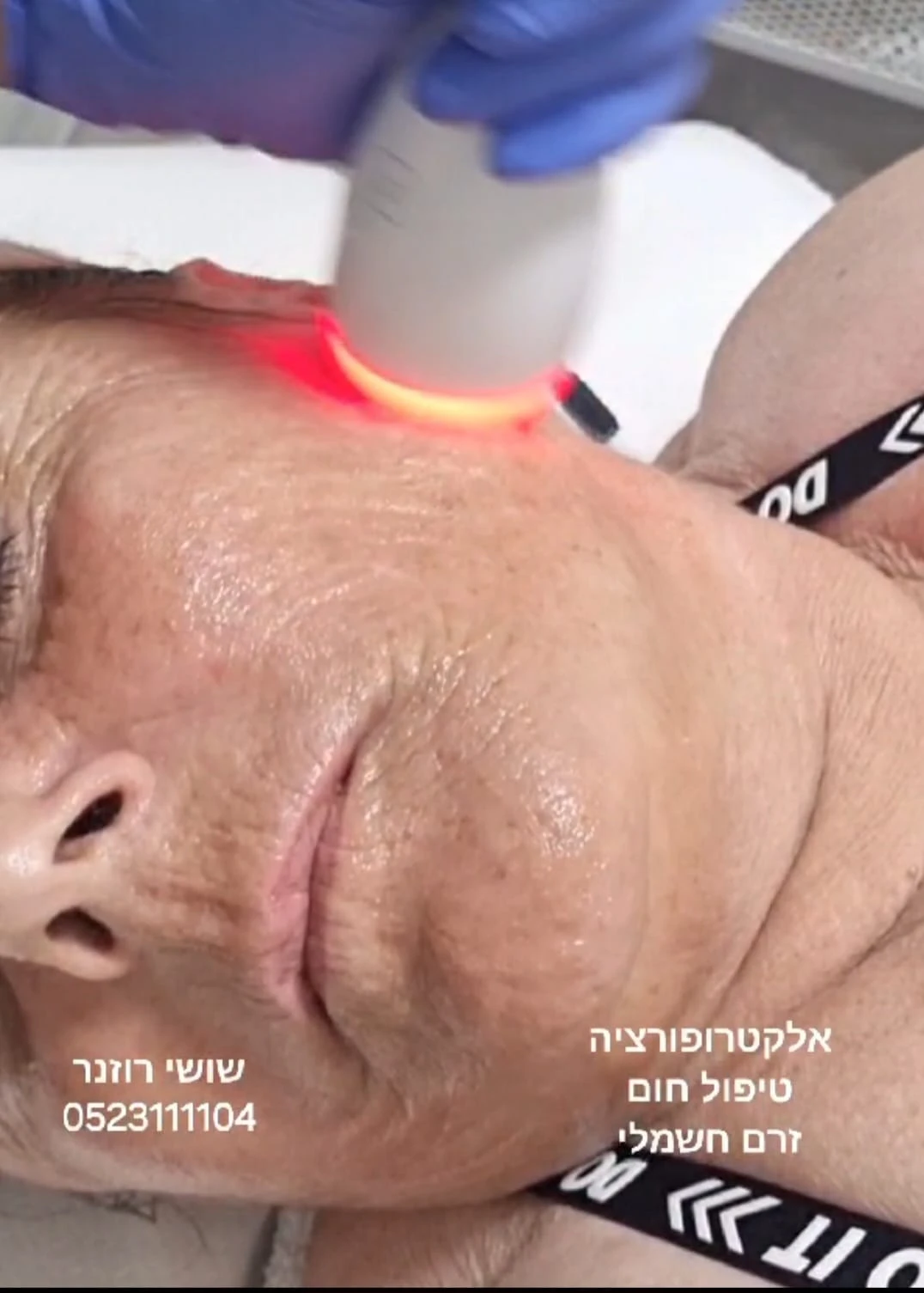 טיפול אלקטרופורציה