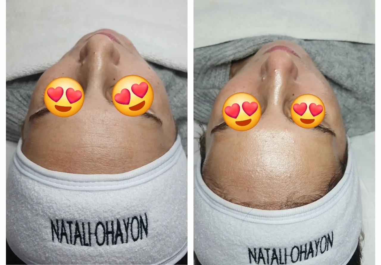 טיפול פנים קלאסי