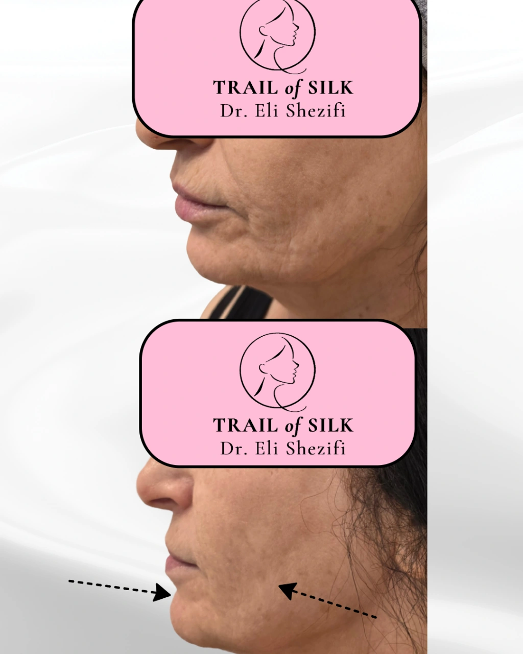 שיפור מרקם העור