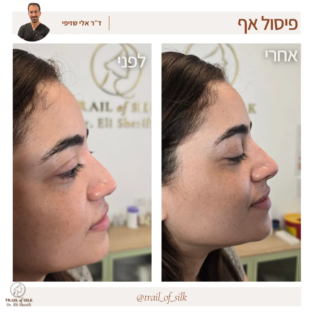  פיסול אף ללא ניתוח