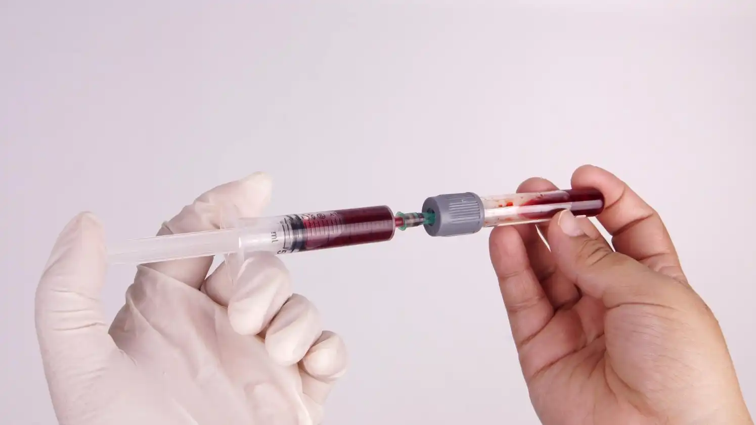 טיפול PRP – התחדשות טבעית של העור באמצעות פלזמה עשירה