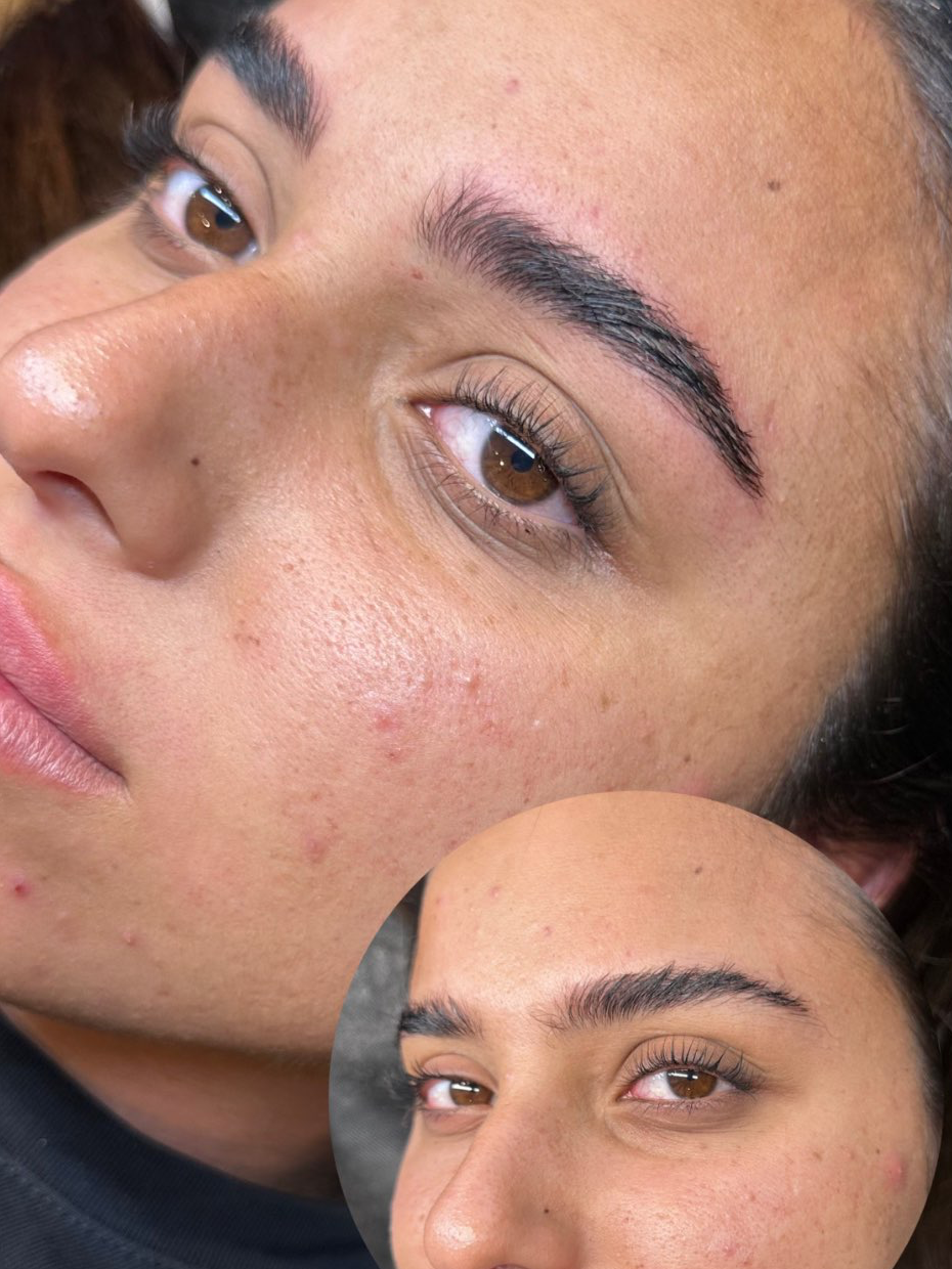 מיקרובליידינג