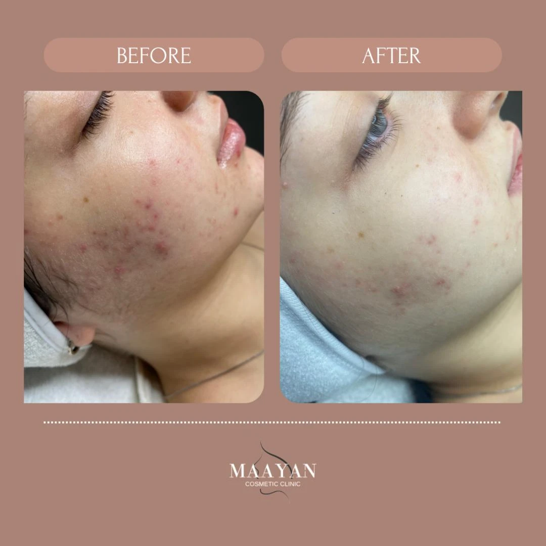 תהליף אקנה , לאחר הטיפול הראשון בלבד!