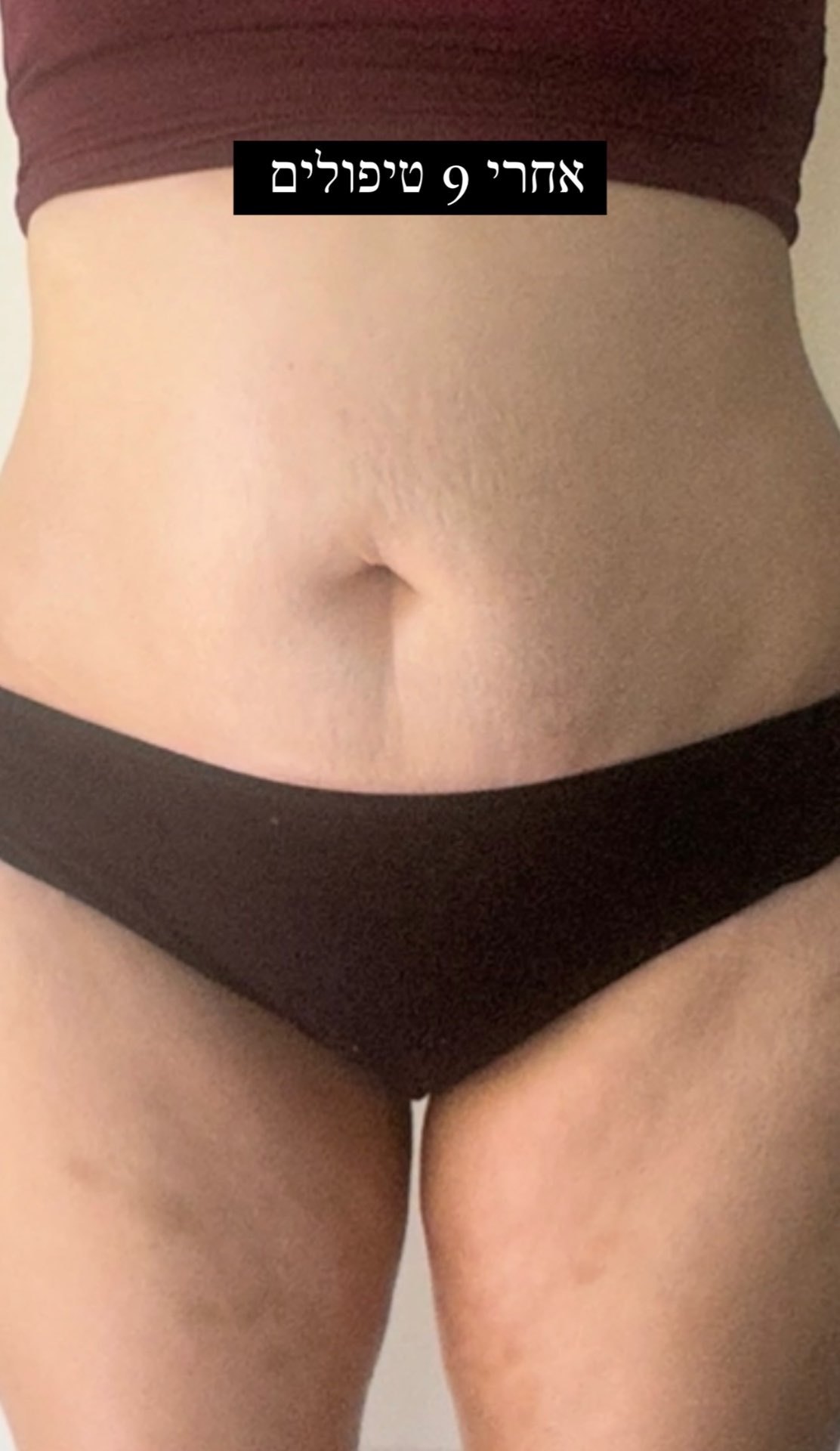 טיפולי גוף משולב - פרסותרפיה וואקום 