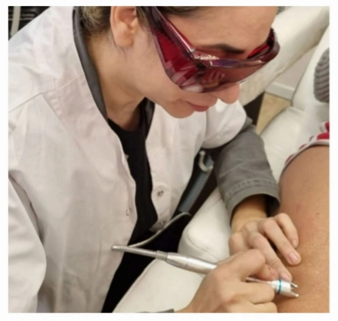 הסרת הנימים