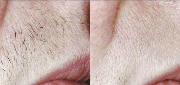 טיפולי לייזר להסרת שיער ללא כאבים