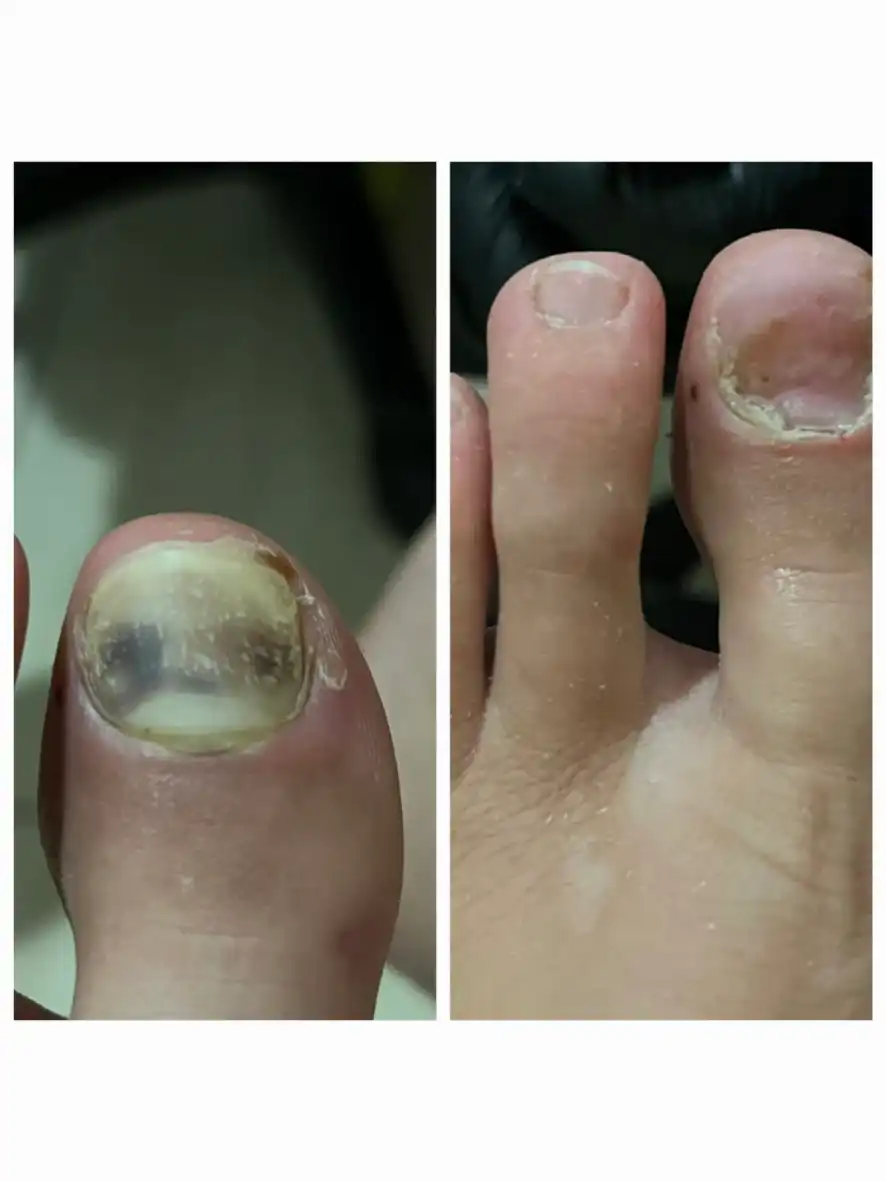פדיקור מקצועי בציפורנים לאחר חבלה וציפורן חודרנית.