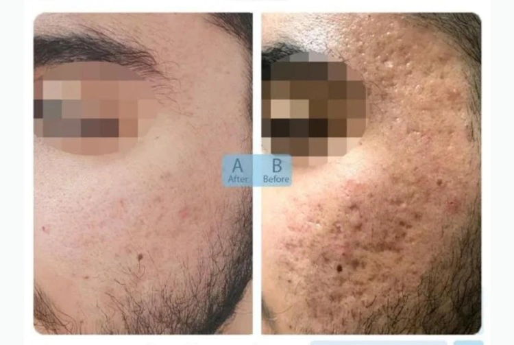 Post acne / microneedling treatments - 300$ - 75 min