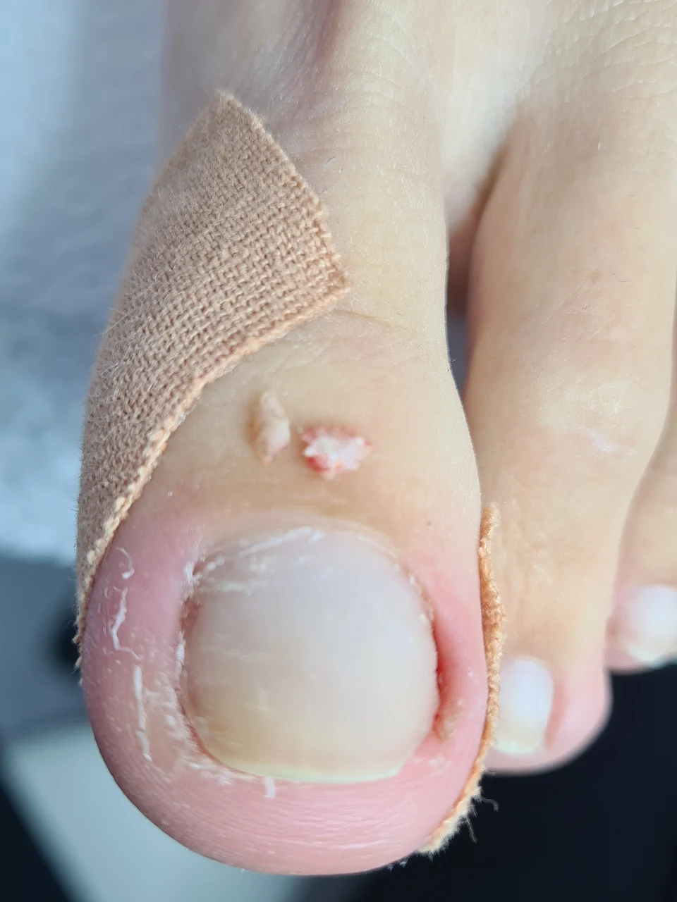 טיפול בהוצאת ציפורן חודרנית