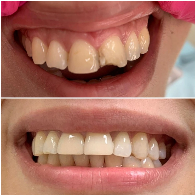 ציפוי חרסינה