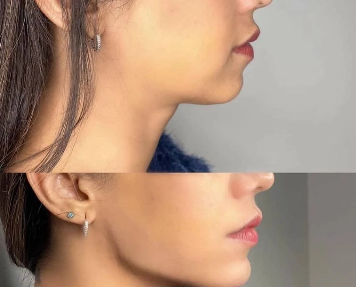 טיפולי אסתטיקה (הזרקות)