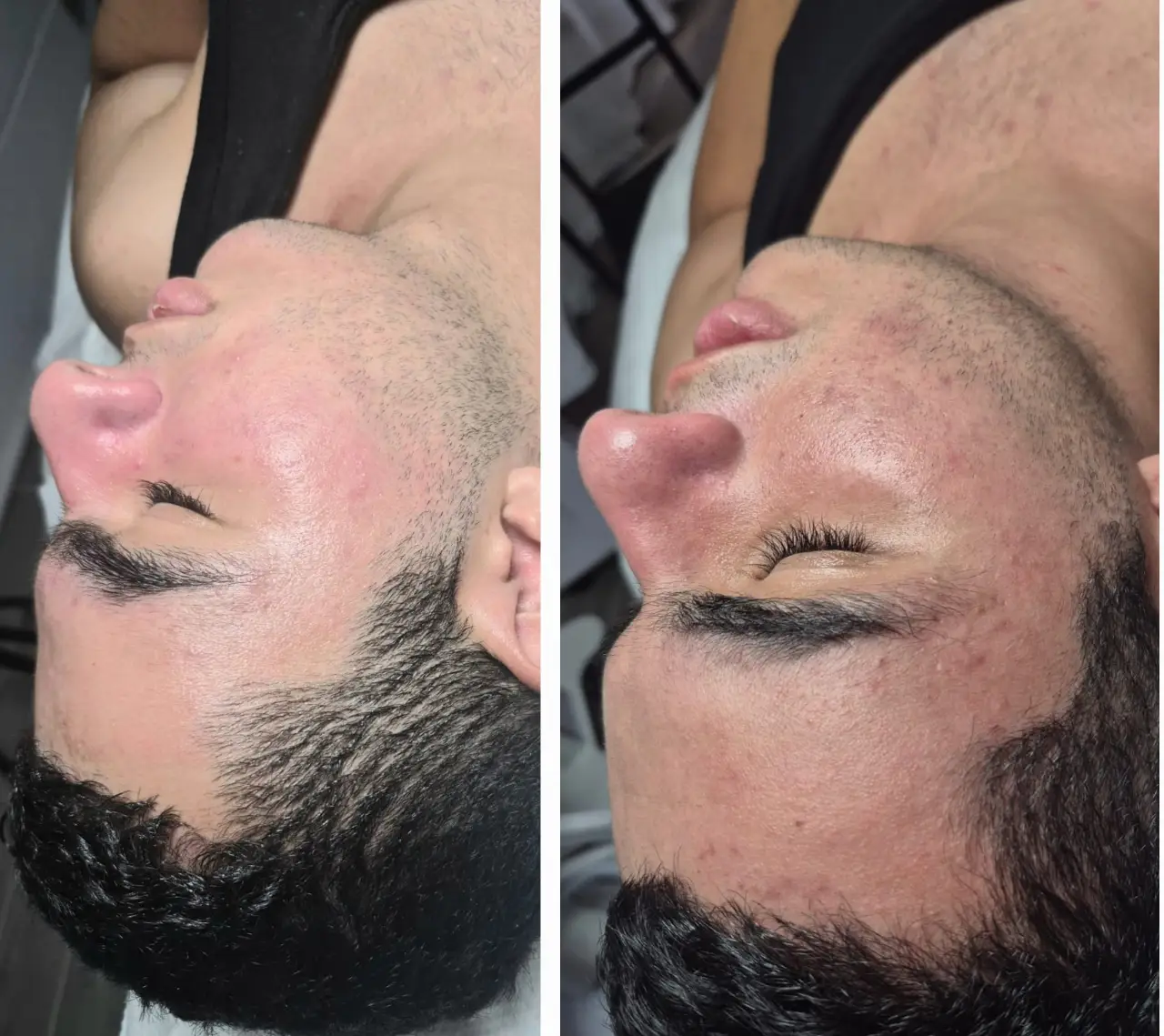  טיפול מיגור דלקת האקנה