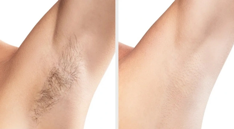 טיפולי לייזר להסרת שיער ללא כאבים