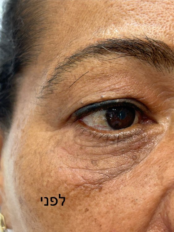 טיפול בקמטים /פלמה Dush פלזמה Nidel