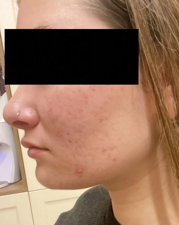 חבילת טיפול באקנה פרימיום