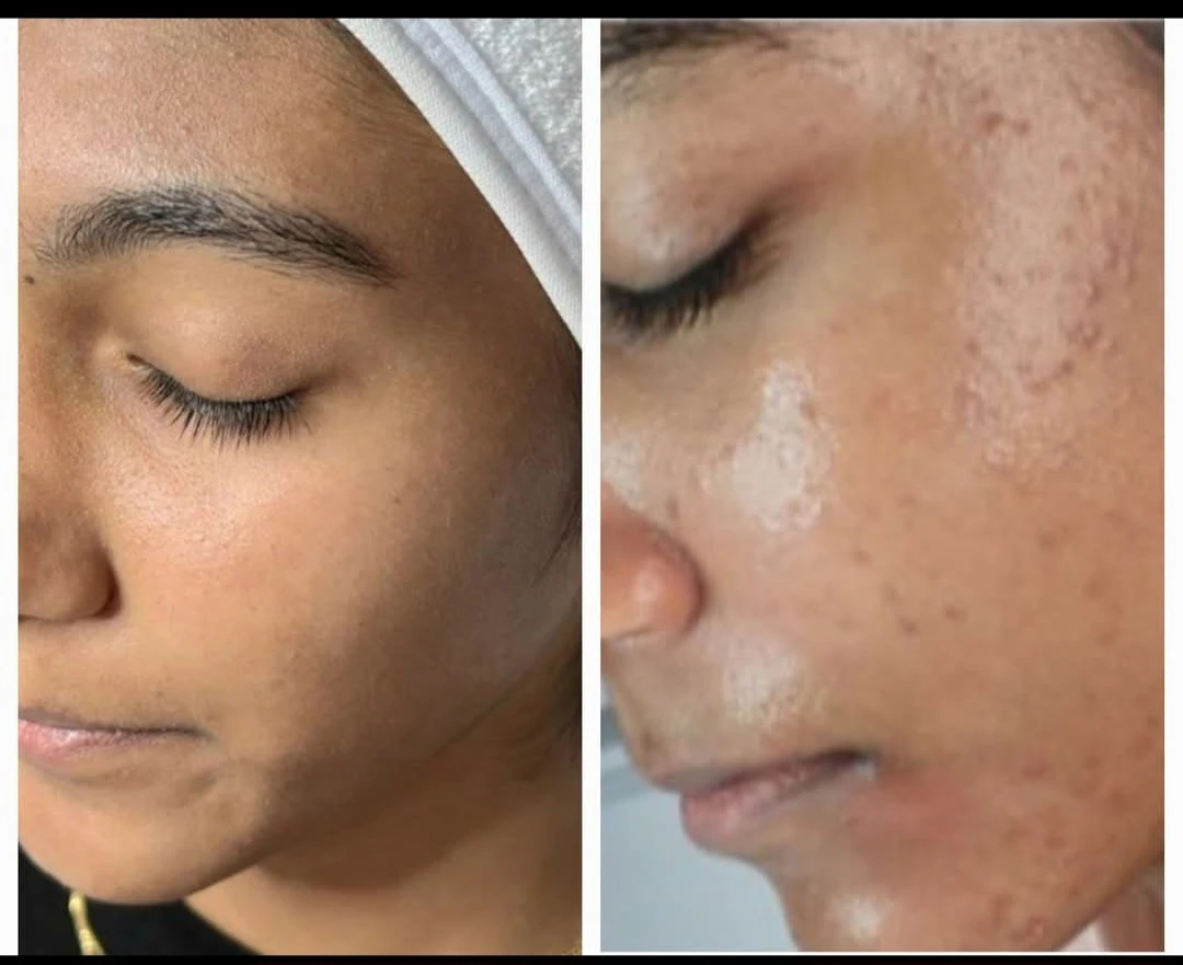 טיפול באקנה 