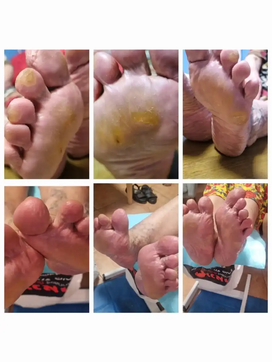 טיפול פדיקור מקצועי ביבלות לחץ.