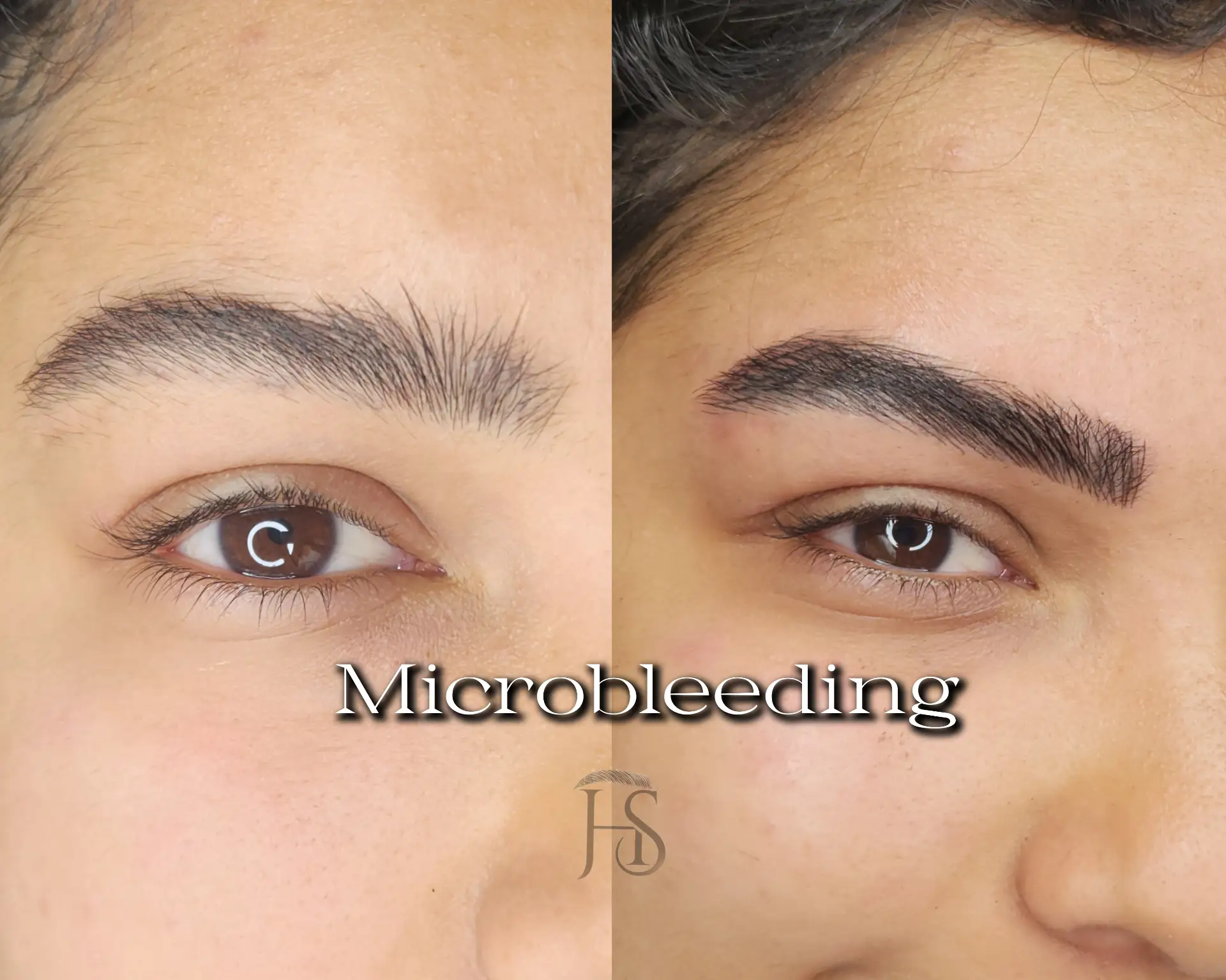 מיקרובליידינג