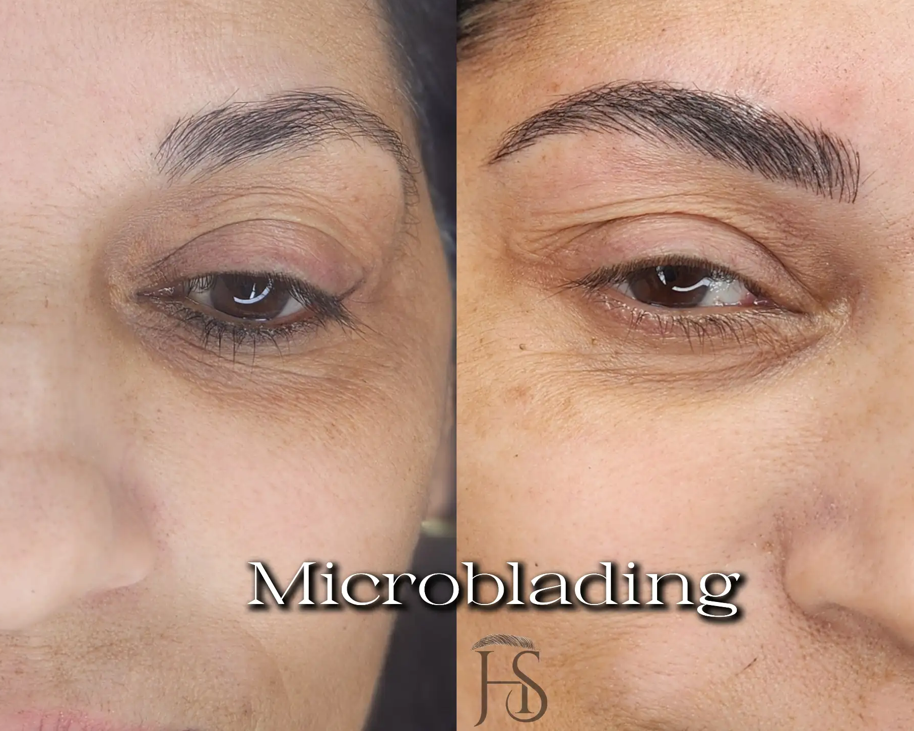 מיקרובליידינג