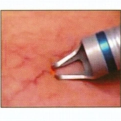 הסרת הנימים