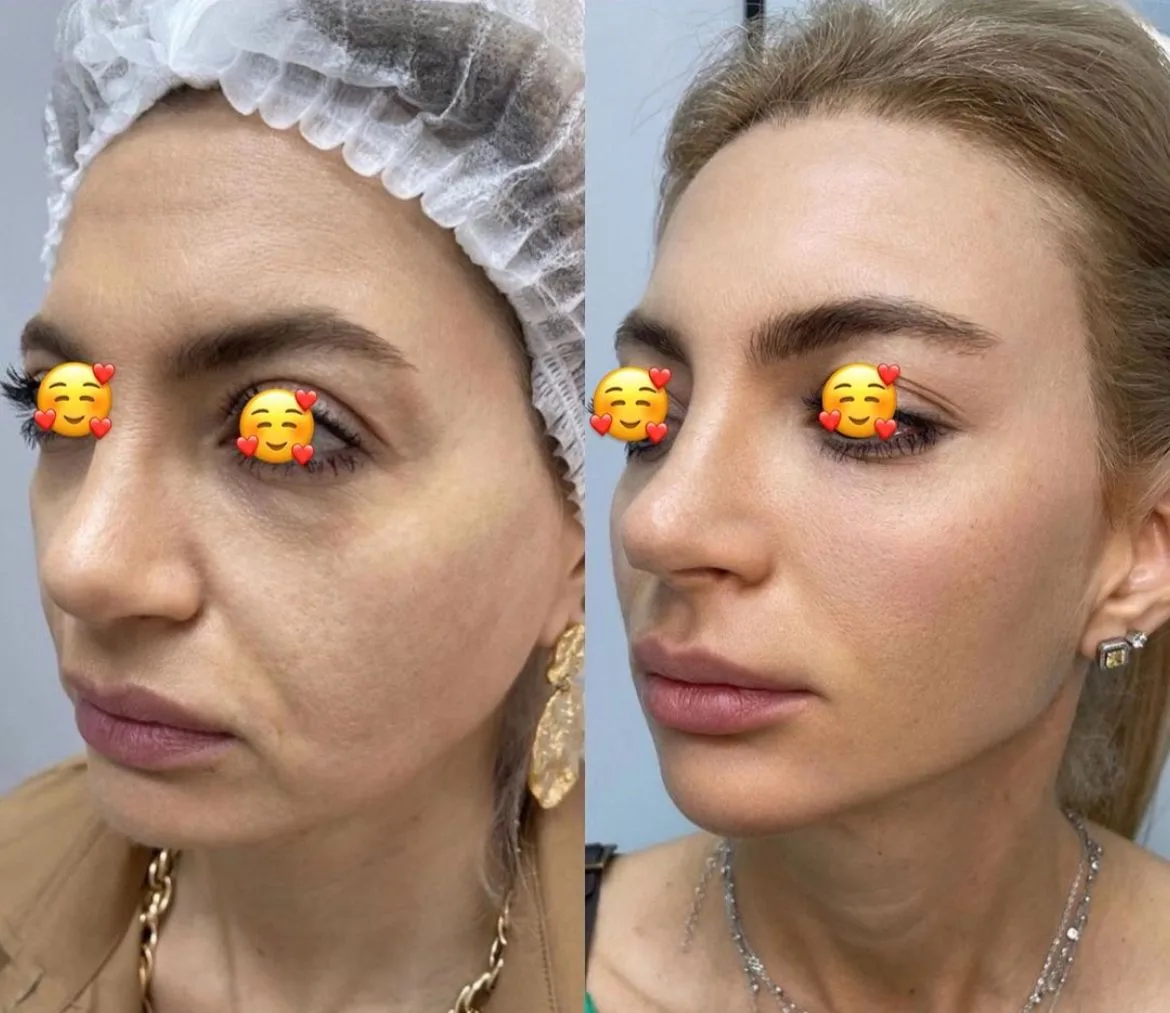 טיפולי אסתטיקה (הזרקות)