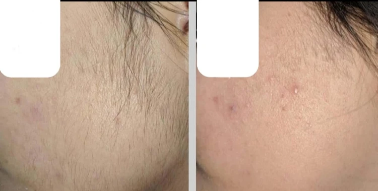 טיפולי לייזר להסרת שיער ללא כאבים