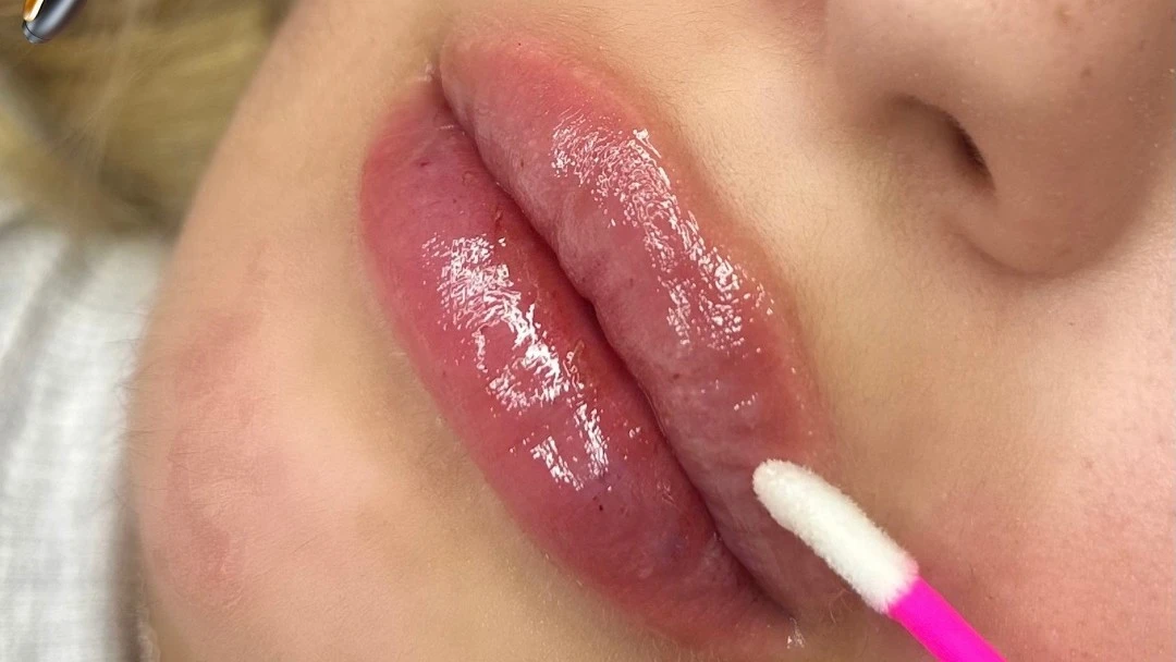 מילוי שפתיים